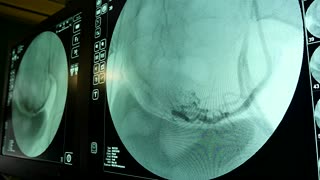 el cáncer de próstata cura al naturalista